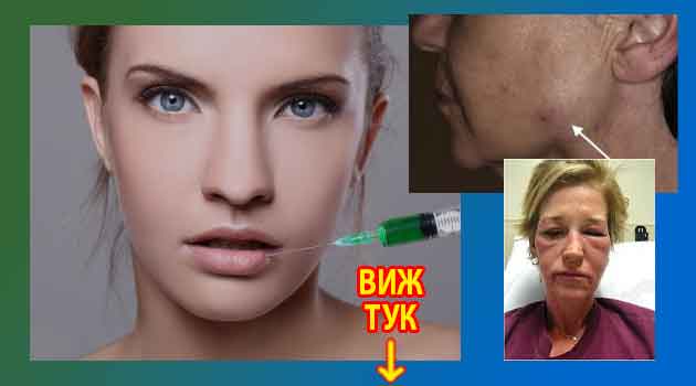 Странични ефекти от хиалуронова киселина, вреди и противопоказания 2 странични ефекти от хиалуронова киселина 4